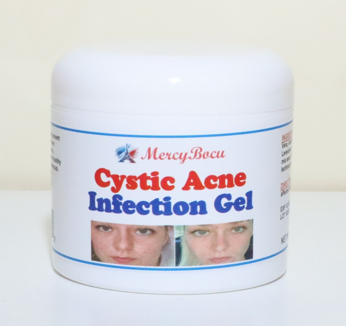 NATURAL SKIN HEALTH CYST ACNE GEL FOR PEOPLE – 100% ORGANICS – MADE IN USA